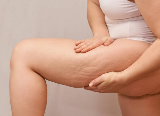 Cellulite