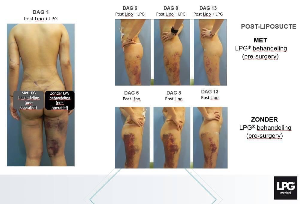 Endermologie bij Liposuctie en overige chirurgische ingrepen.