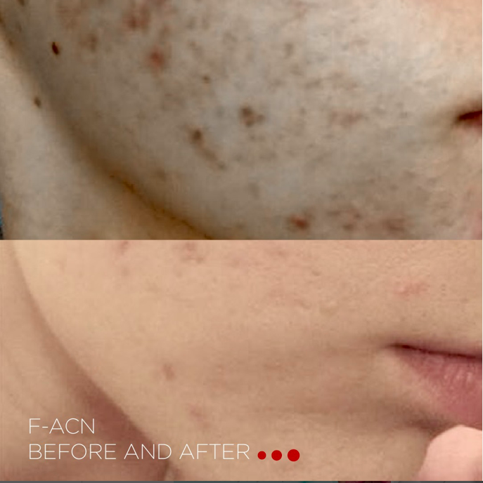 Behandeling door middel van microneedling