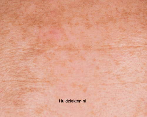 Melasma en chloasma (zwangerschapsmasker)