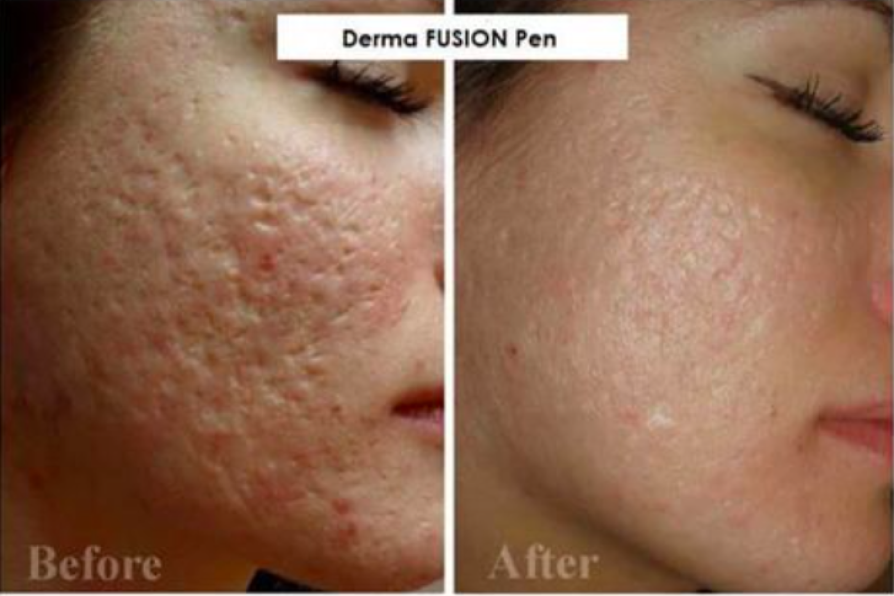 Acne en acnelittekens