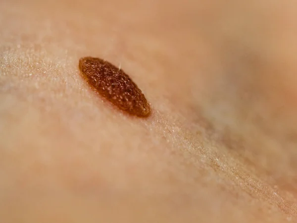 Moedervlekken (Neavi Naevocellularis)