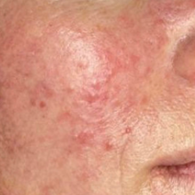 Rosacea