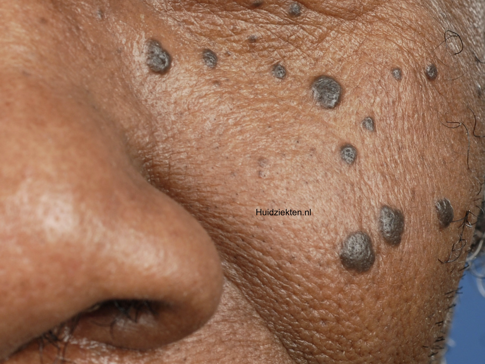 Dermatosis papulosa nigra