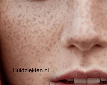 Sproeten (ephelides)