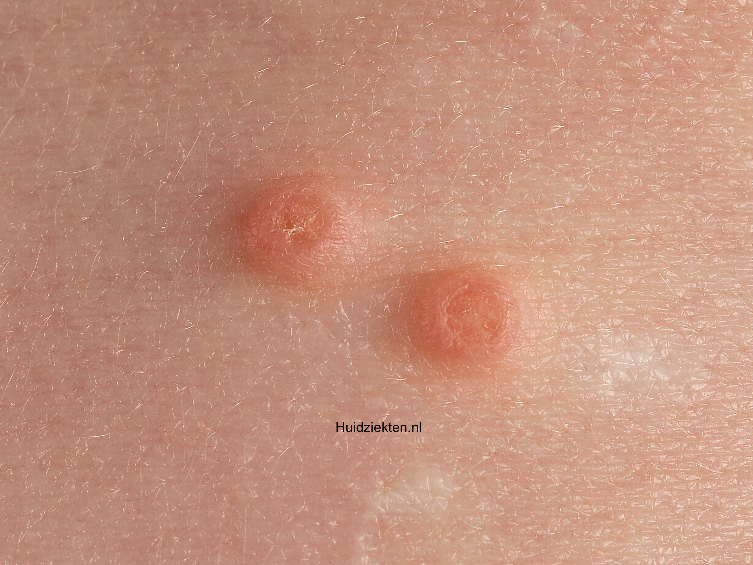 Waterwratjes (Molluscum contagiosa)